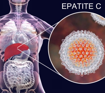Epatite C (HCV)